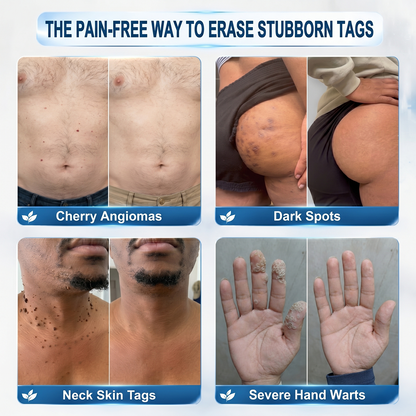 Wait — one last thing before you go…  We have a small overstock batch that didn’t go into regular sale.  👉 You can add 1 more Hiskin® for 80% OFF  ⚠ This is NOT a public offer ⚠ Once this page is closed, it’s gone